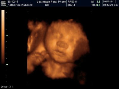 3D ultrasound showing a fetus’s face in warm orange tones on a black background