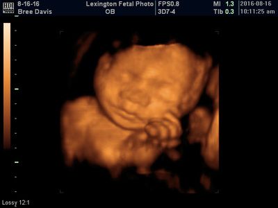 3D ultrasound showing a fetus in the womb, with amber tones on a black background