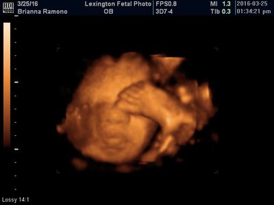 3D ultrasound image of a fetus curled in the womb, rendered in orange tones