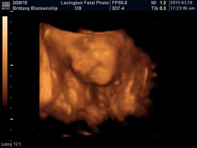 Ultrasound scan showing a fetus in sepia tones with clinical on-screen labels.