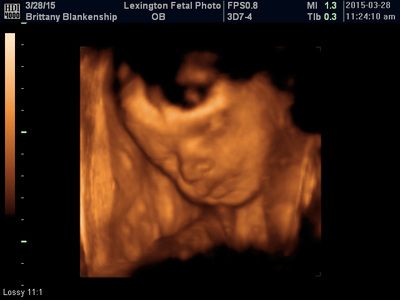 3D ultrasound of a fetus in the womb, showing the face and upper body in sepia tones