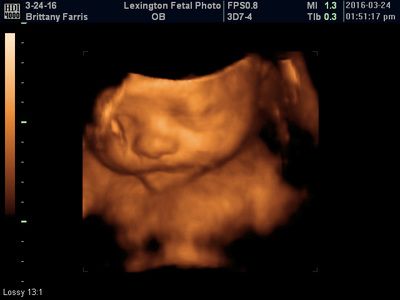 3D ultrasound of a fetus curled in the womb, shown in warm orange tones