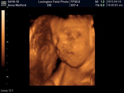3D ultrasound scan of a fetus with a clear facial profile in warm orange tones