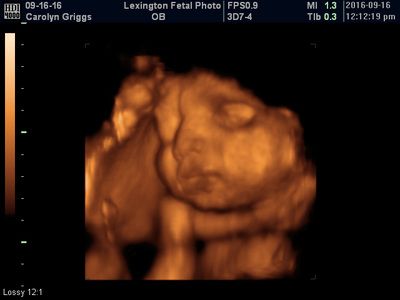 3D ultrasound scan of a fetus in orange tones against a black background