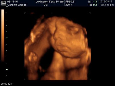 3D ultrasound scan showing a fetus curled in the womb, with orange-brown shading and medical overlay text