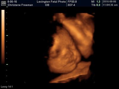 Ultrasound scan showing a fetus in the womb, in orange on a black background.