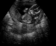 Grayscale ultrasound scan showing a fetus in the womb