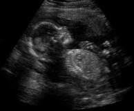 Ultrasound scan showing a fetus in the womb