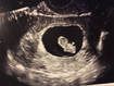 Ultrasound scan showing an early pregnancy with a gestational sac and embryo in the uterus