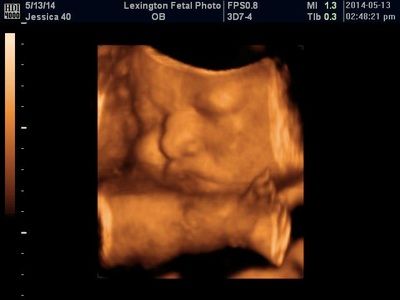 Ultrasound scan showing a fetus in the womb with measurement overlays and dark background