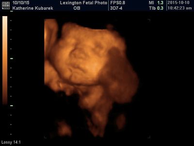 3D ultrasound of a fetus in the womb, shown in warm orange tones with medical scan overlays