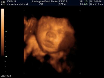 3D ultrasound of a fetus in the womb, shown in sepia tones on a medical monitor.