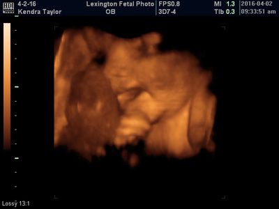 3D ultrasound of a fetus in warm orange tones against a black background