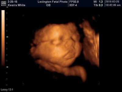 3D ultrasound scan showing a fetus in the womb, warm orange tones against a black background