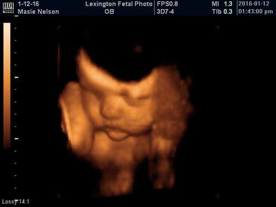 3D ultrasound of a fetus in the womb, shown in amber tones against a black background