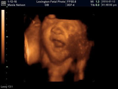 3D ultrasound of a fetus’s face, in warm orange tones, with medical scan labels visible