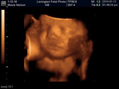 3D ultrasound scan showing a fetus in orange tones inside the womb