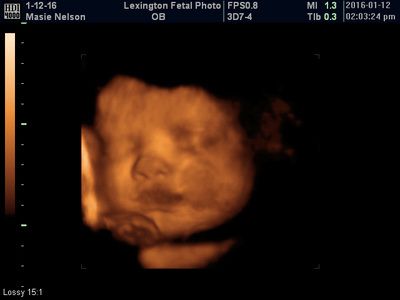 3D ultrasound scan showing a fetus in the womb, glowing orange on a black background