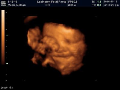 Orange 3D ultrasound scan of a fetus in the womb on a black background