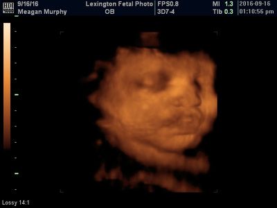 3D ultrasound image showing a fetus’s face in orange tones on a black background