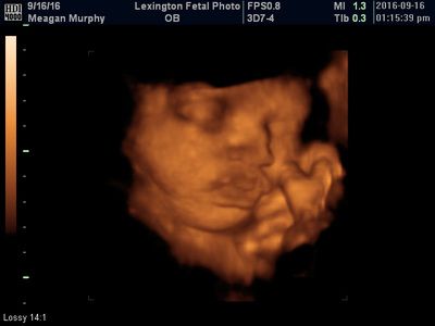 3D ultrasound of a fetus in the womb, shown in sepia tones with scan data on screen