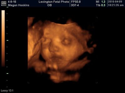 3D ultrasound image of a fetus in the womb, shown in warm sepia tones.
