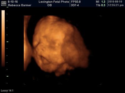Orange 3D ultrasound scan of a fetus in the womb