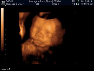 3D ultrasound scan of a fetus in the womb, shown in sepia tones with monitor text overlay