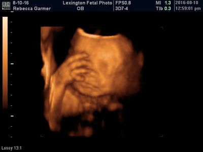 3D ultrasound image of a fetus in warm orange tones against a black background