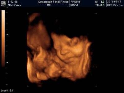 3D ultrasound scan showing a baby’s face in orange tones against a black background