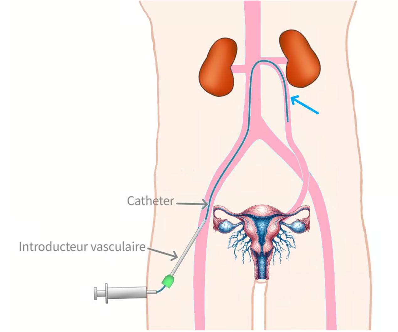 schéma embolisation varices pelviennes