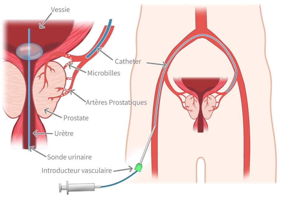 schéma embolisation de prostate