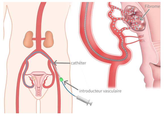 Embolisation utérine
