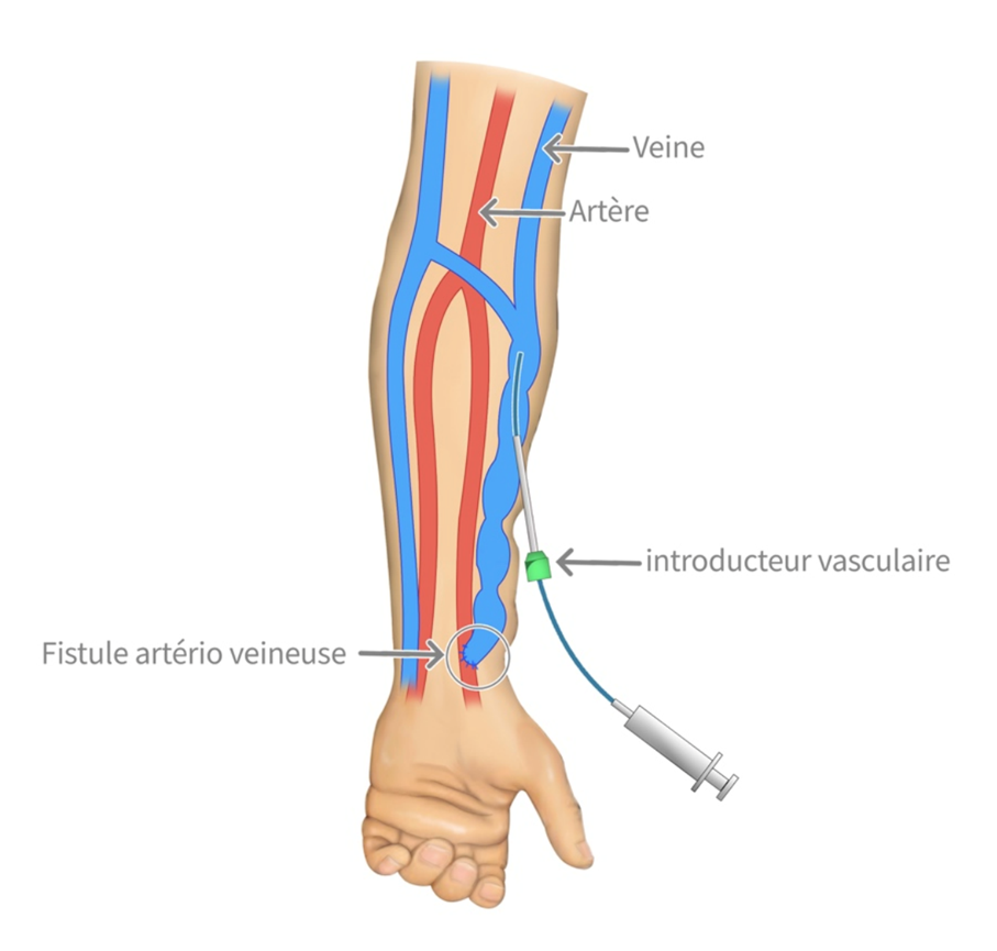 schéma fistule de dialyse