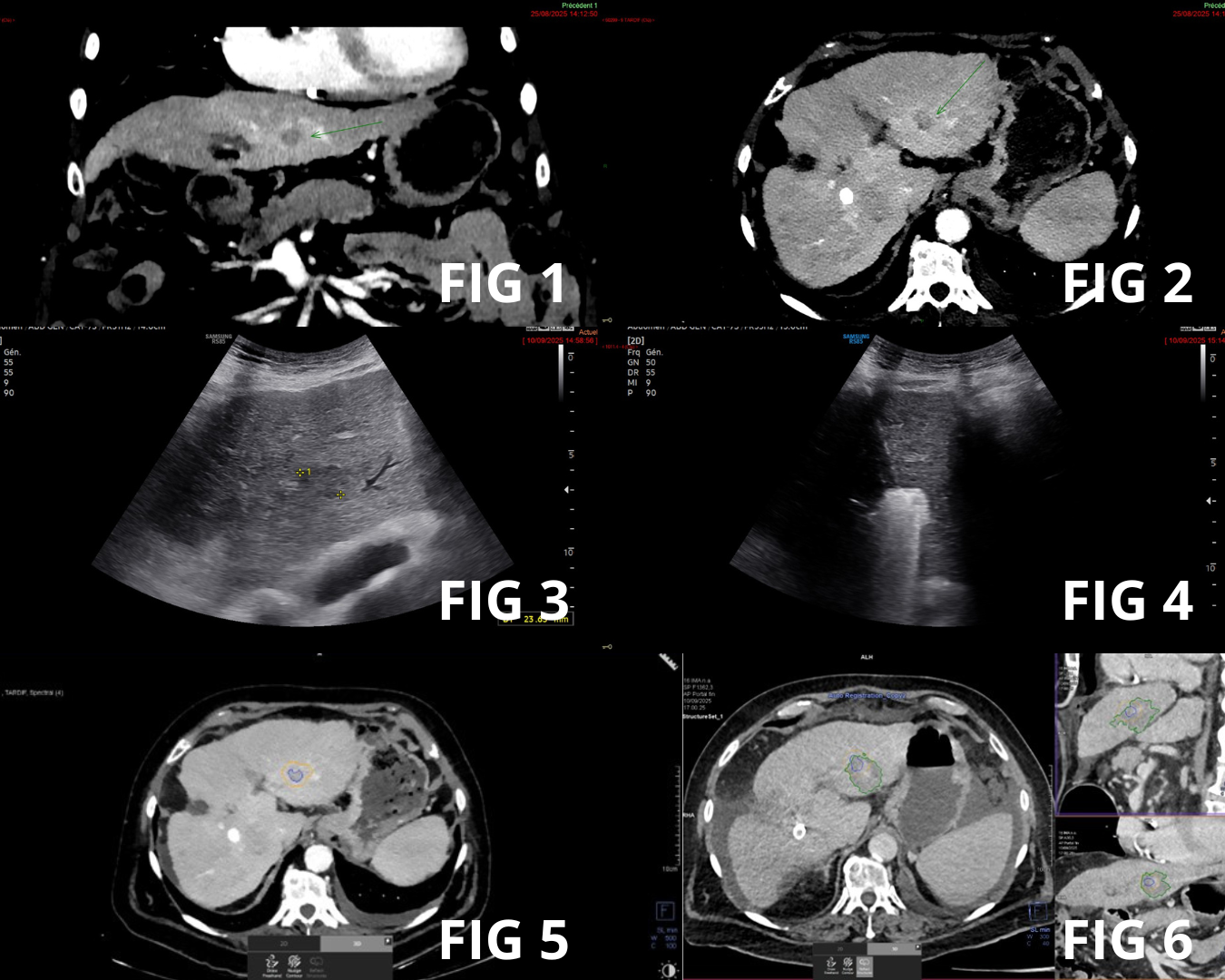 Varian Siemens Healthineers hepatic microwave ablation system Varian Siemens Healthineers hepatic microwave ablation system