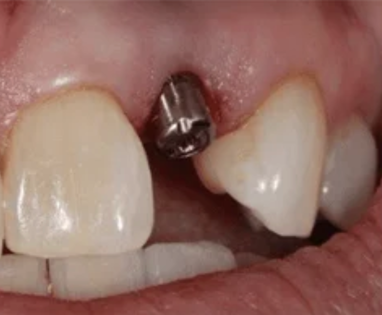 Close-up of a dental implant screw between front teeth in a mouth