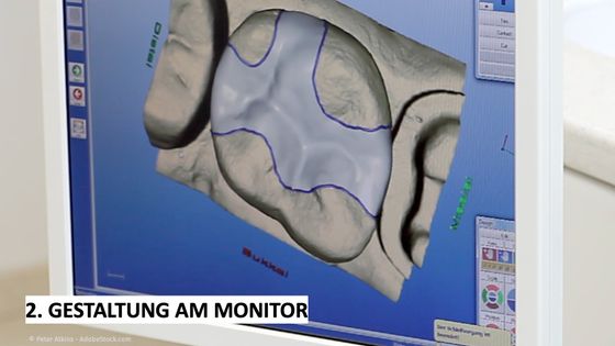 CEREC: Konstruktion am Monitor