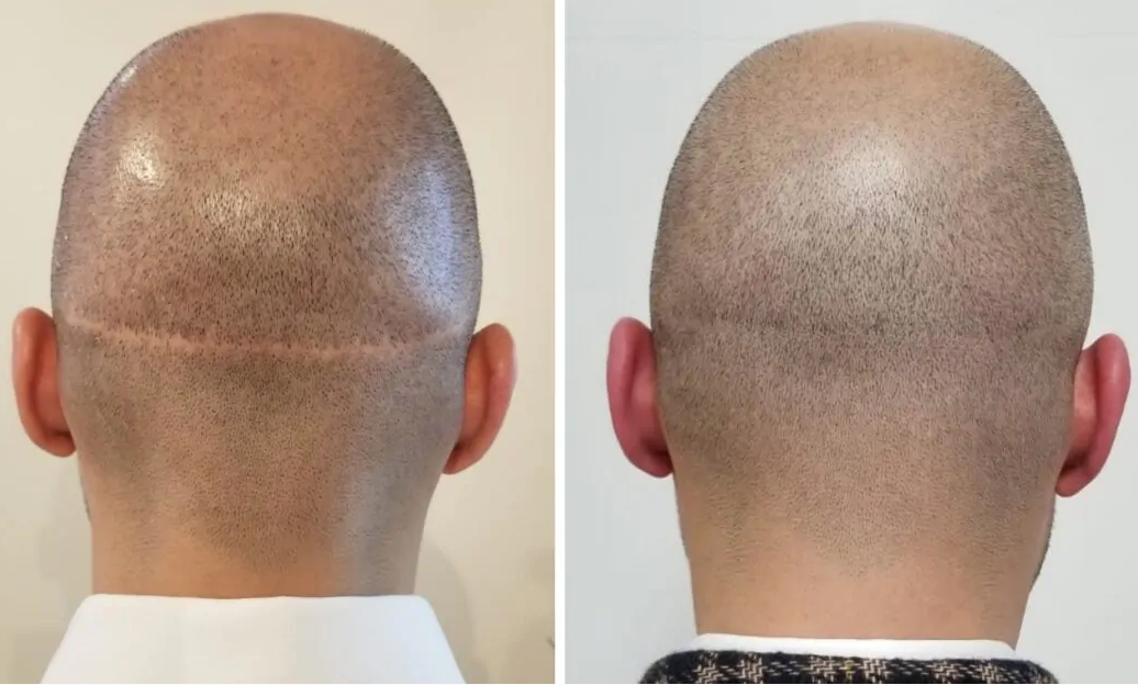 scalp micropigmentation 