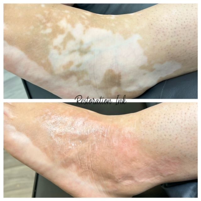 Vitiligo treatment with camouflage ink
