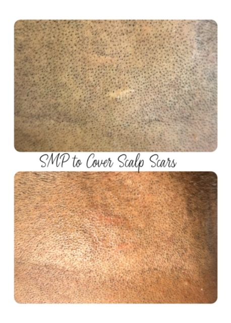 Scalp Micropigmentation, scalp scar, smp 