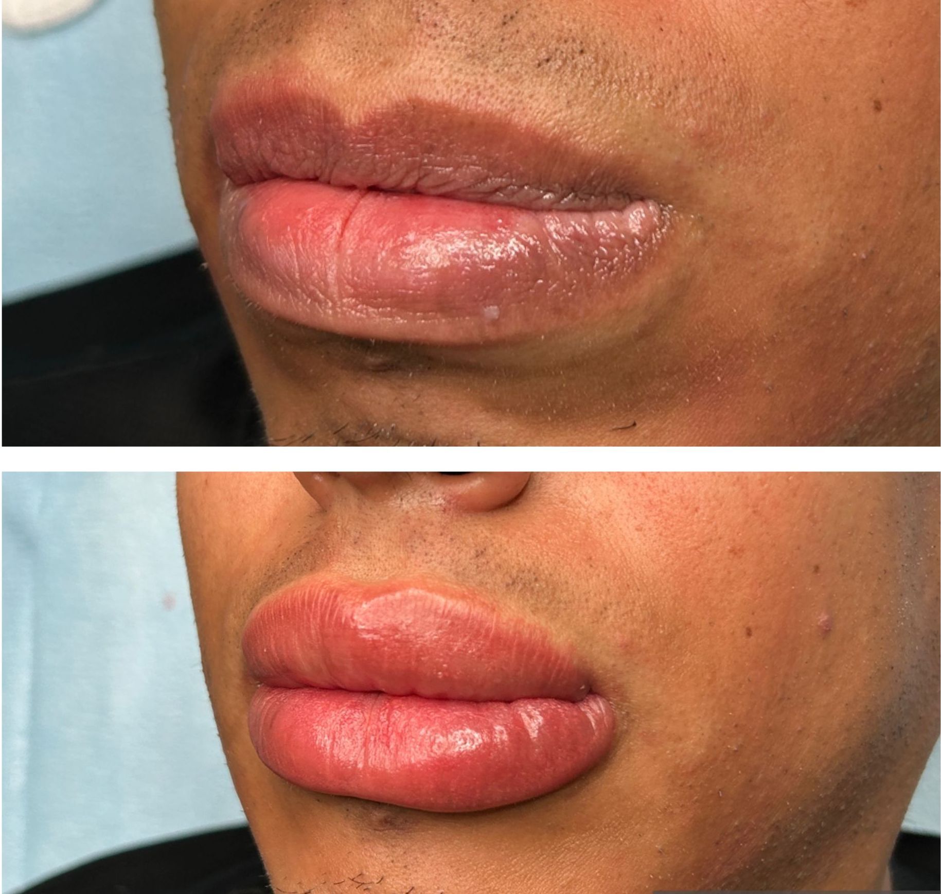 Lip neutralization in Albuquerque