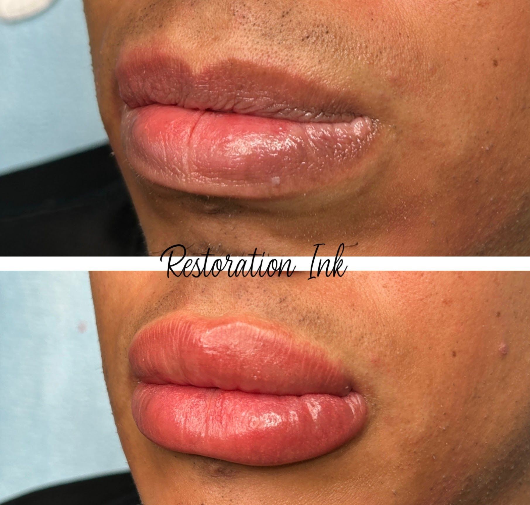 Lip Neutralizatioin 