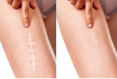 scar camouflage before and after in Albuquerque, nm