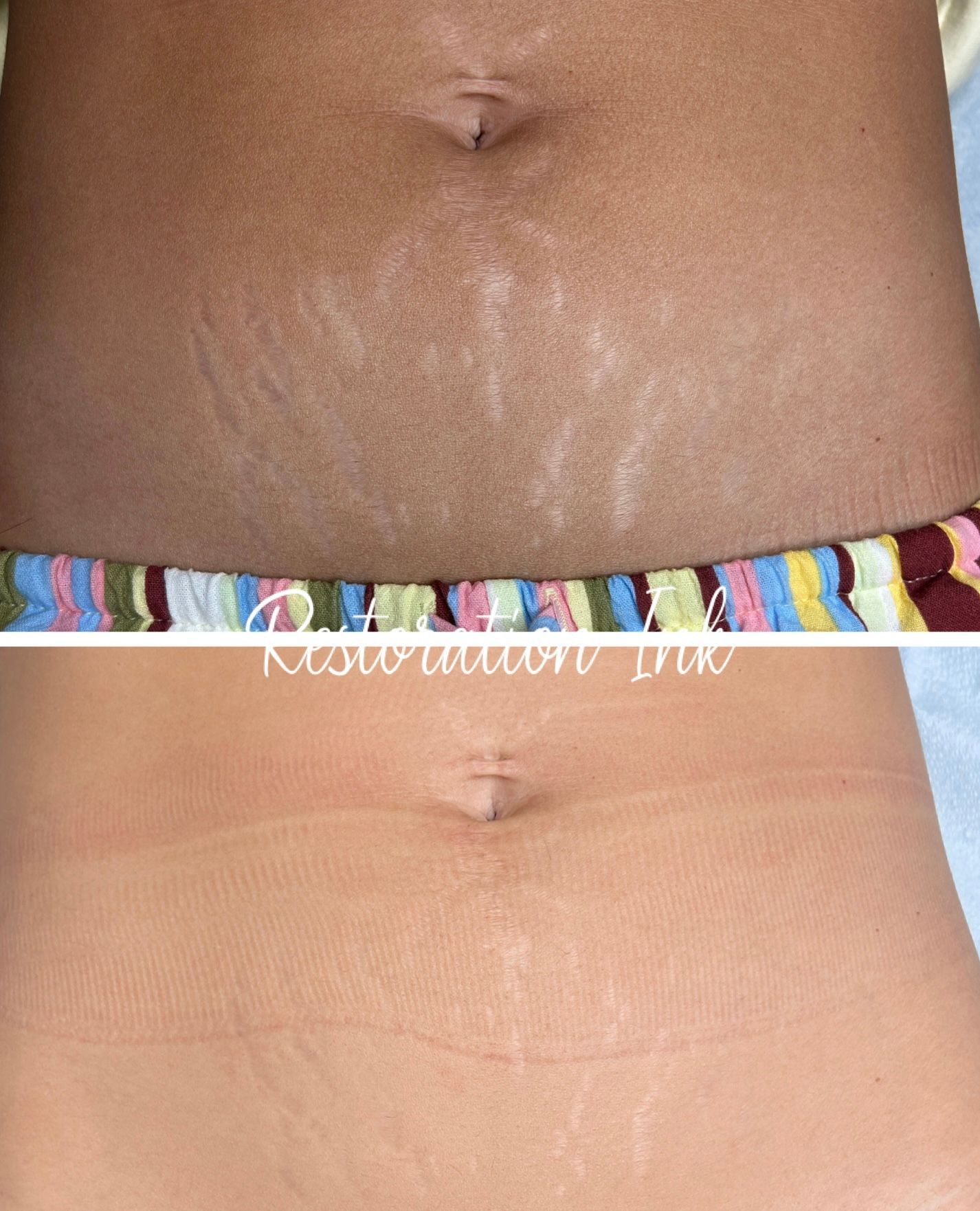 Stretch mark treatment in Albuquerque