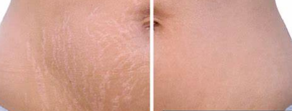 stretch mark treatment 
