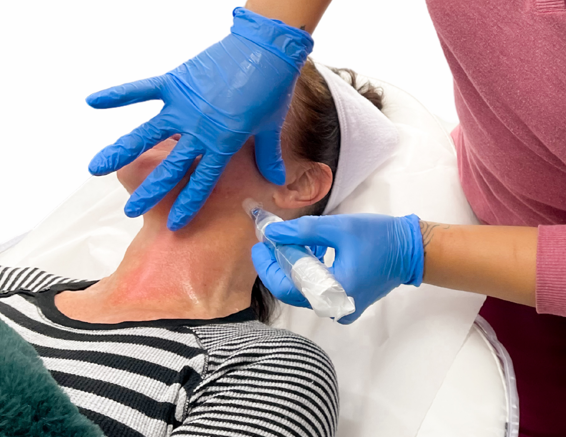 Person receiving cosmetic microneedling in the neck from a healthcare professional wearing blue gloves.