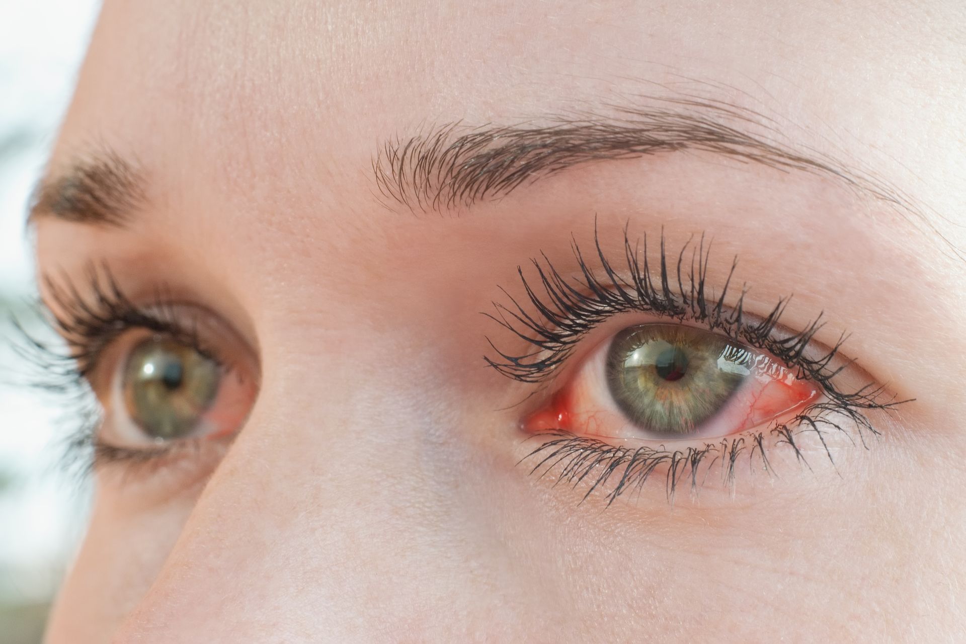 Close-up of eyes with red, irritated inner eyelids and visible contact lenses