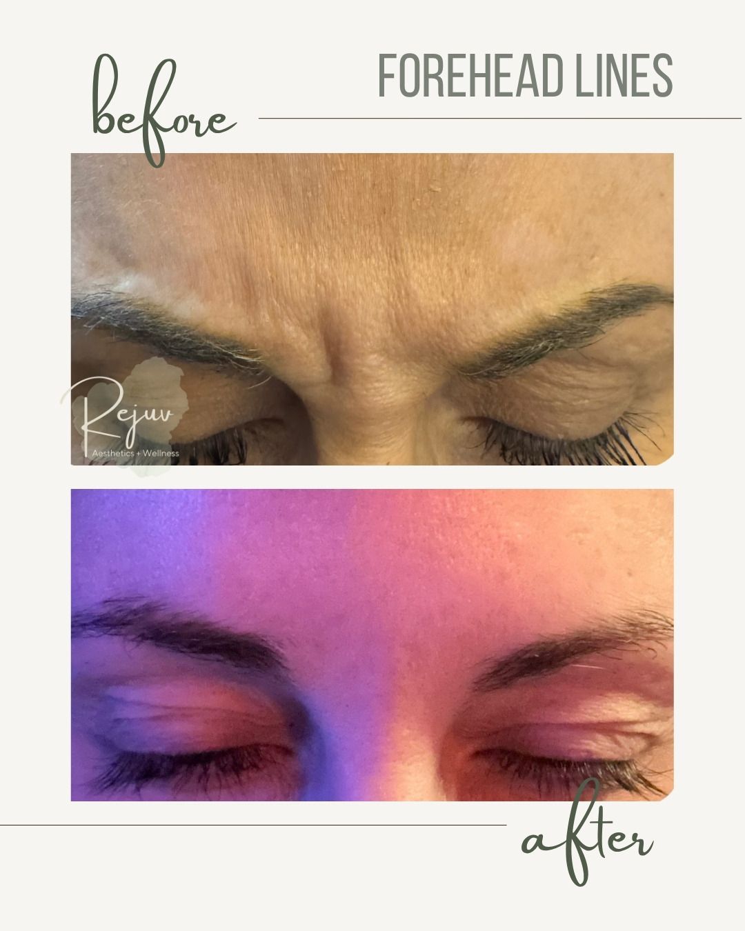 Before-and-after close-up of forehead lines, showing reduced wrinkles after treatment.