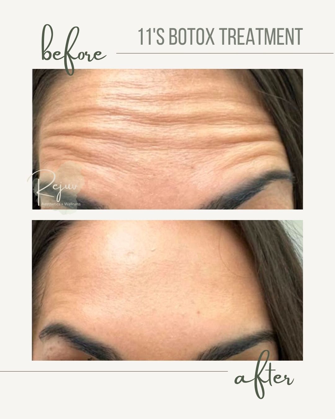 Before-and-after close-up of forehead wrinkles labeled “11’s Botox treatment” and “before”/“after”.