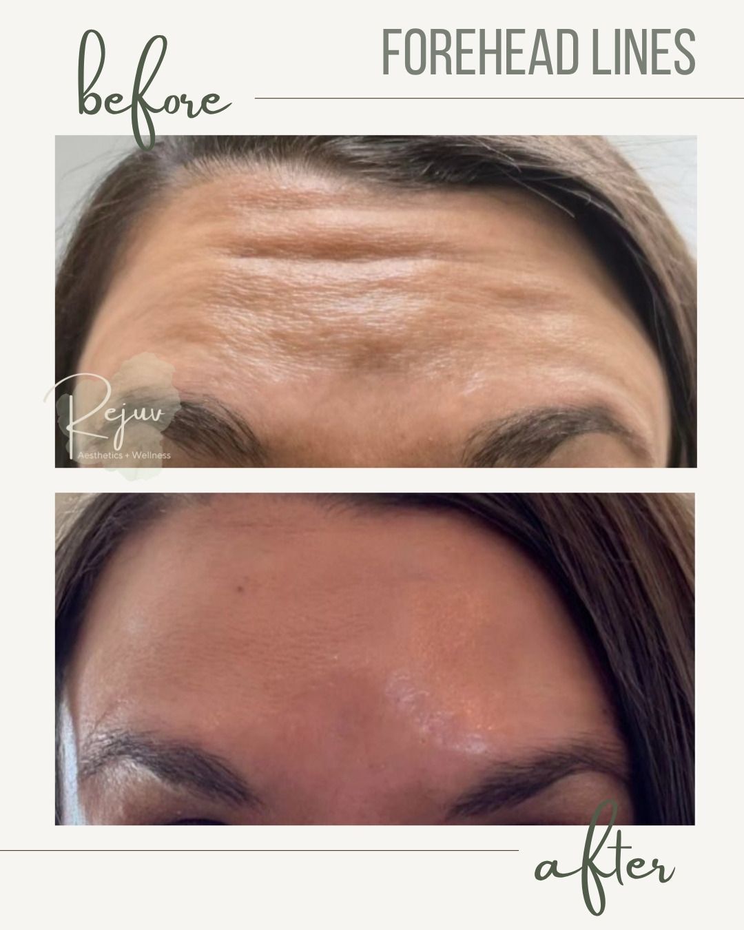 Before-and-after close-up of forehead lines, showing smoother skin in the after image.